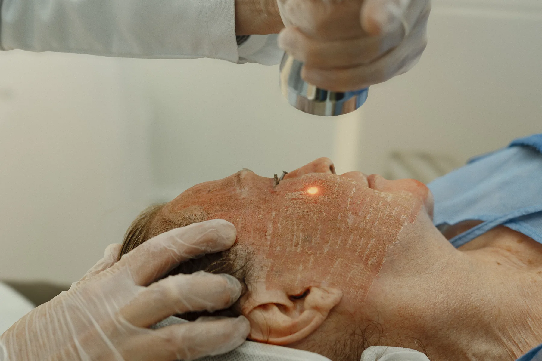 rejuvenecimiento facial con laser erbio